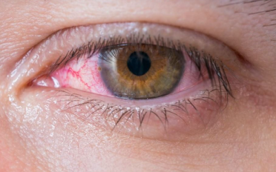 USO DE MASCARILLAS Y OJO ROJO
