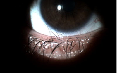 ¿Pueden crecer las pestañas hacia dentro del ojo?