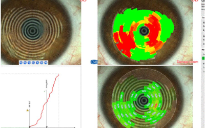 ¿CÓMO SÉ SI TENGO OJO SECO?